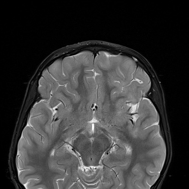 File:Acute disseminating encephalomyelitis with bilateral optic neuritis (Radiopaedia 79676-92886 Axial STIR 13).jpg