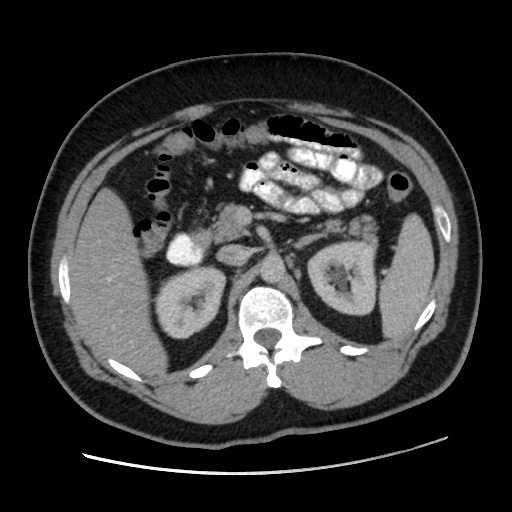 Acute diverticulitis with localized perforation (Radiopaedia 41296-44113 Axial C+ portal venous phase 32).jpg
