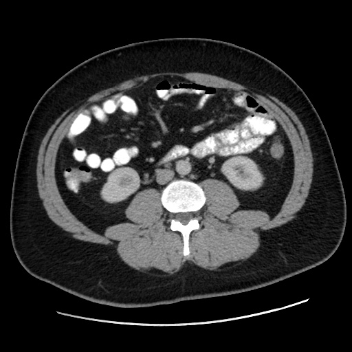 Acute diverticulitis with localized perforation (Radiopaedia 41296-44113 Axial C+ portal venous phase 48).jpg
