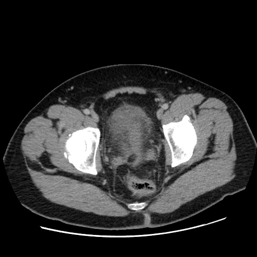 Acute diverticulitis with localized perforation (Radiopaedia 41296-44113 Axial C+ portal venous phase 84).jpg