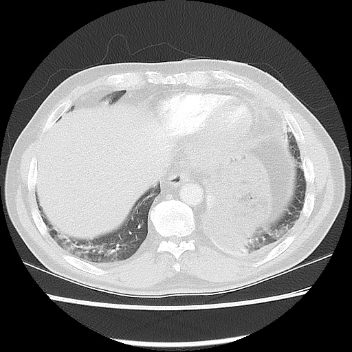 File:Acute epicardial fat necrosis (Radiopaedia 42327-45440 Axial lung window 45).jpg