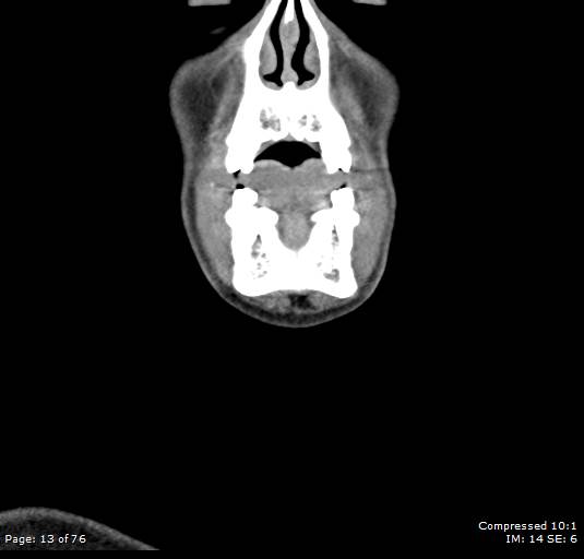 File:Acute epiglottitis (Radiopaedia 54375-60590 Coronal C+ arterial phase 13).jpg