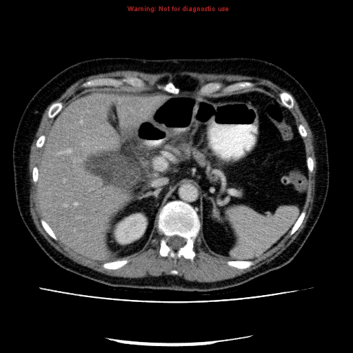 Acute gangrenous cholecystitis (Radiopaedia 10123-10661 Axial C+ portal venous phase 27).jpg