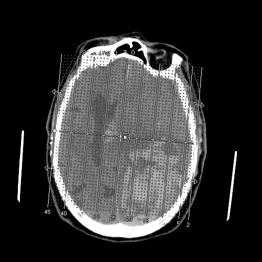 File:Acute hemorrhagic stroke (Radiopaedia 17507-17223 Sagittal non-contrast 1).jpg