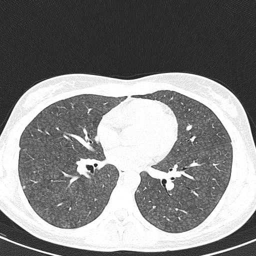 File:Acute hypersensitivity pneumonitis (Radiopaedia 85293-100870 Axial lung window 66).jpg