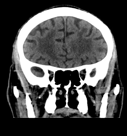 File:Acute left anterior cerebral artery territory infarction (Radiopaedia 51785-57578 Coronal non-contrast 18).jpg