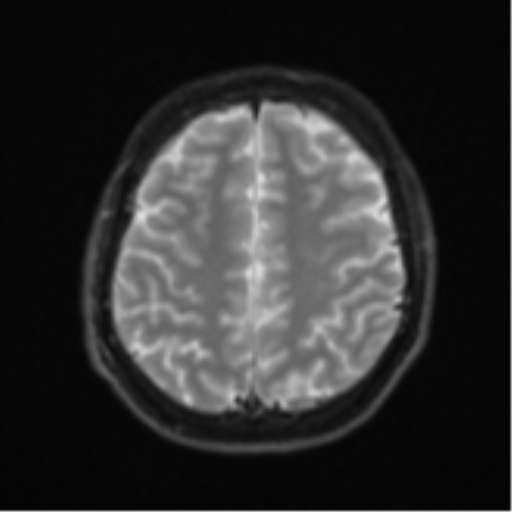 Acute left middle cerebral artery territory infarct with clot retrieval (Radiopaedia 47732-52433 Axial DWI 23).png