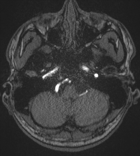 Acute left middle cerebral artery territory infarct with clot retrieval (Radiopaedia 47732-52433 Axial MRA 10).png