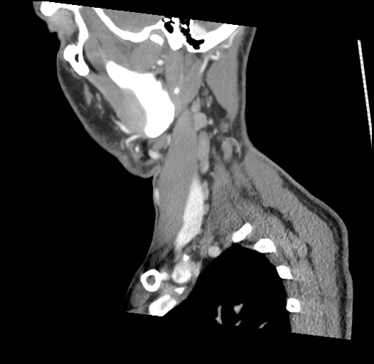 Acute longus colli calcific tendinitis (Radiopaedia 72495-83036 Sagittal C+ arterial phase 54).jpg
