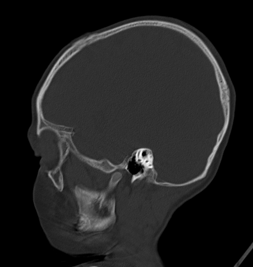 File:Acute mastoiditis (Radiopaedia 82678-96881 Sagittal bone window 15).jpg