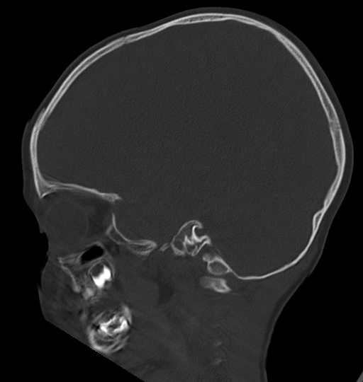Acute mastoiditis (Radiopaedia 82678-96881 Sagittal bone window 43).jpg
