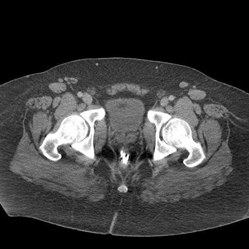 Acute mesenteric venous ischemia (Radiopaedia 46041-50383 Axial C+ portal venous phase 139).jpg