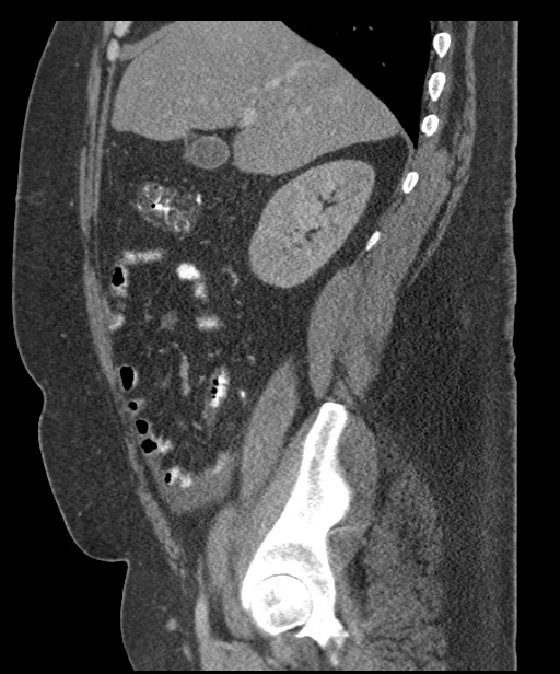 Acute mesenteric venous ischemia (Radiopaedia 46041-50383 Sagittal C+ portal venous phase 34).jpg