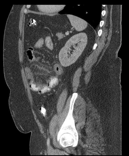 Acute mesenteric venous ischemia (Radiopaedia 46041-50383 Sagittal C+ portal venous phase 84).jpg
