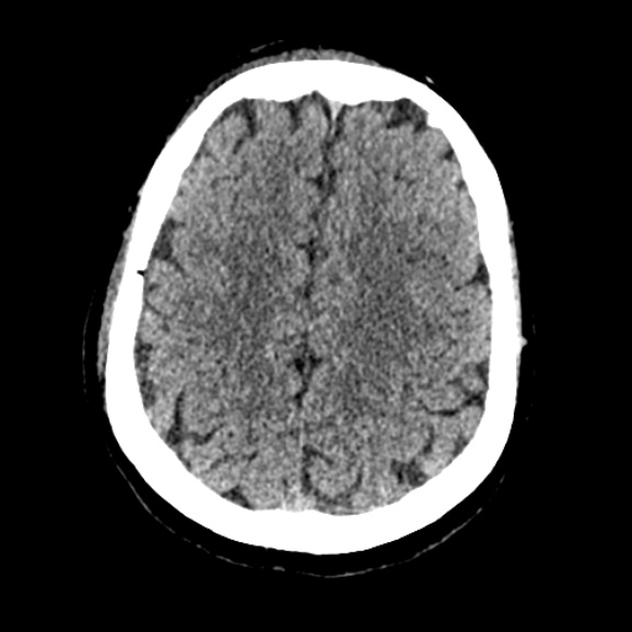 Acute middle cerebral artery territory infarct (Radiopaedia 52380-58283 Axial non-contrast 79).jpg