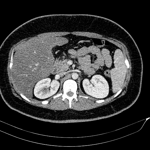 Acute on chronic pancreatitis (Radiopaedia 80902-94423 Axial C+ portal venous phase 62).jpg