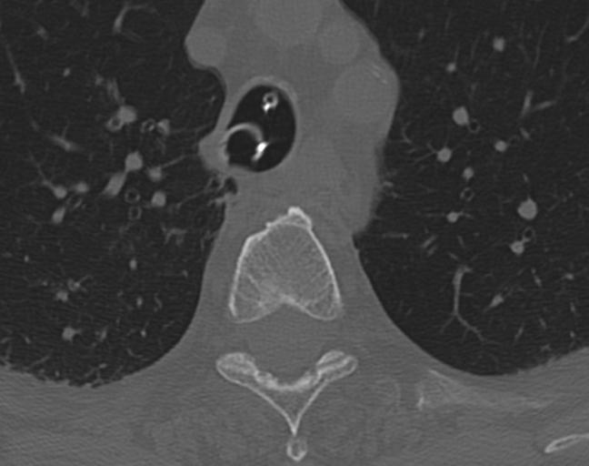 Acute on chronic subdural hematoma and thoracic vertebral injury in a multitrauma patient (Radiopaedia 31698-32619 Axial bone window 76).jpg