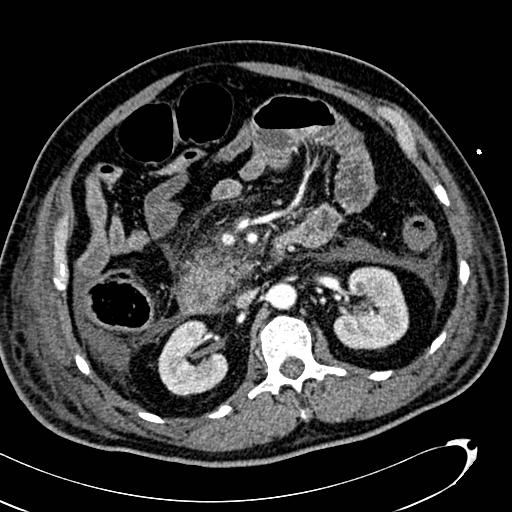 File:Acute pancreatic necrosis (Radiopaedia 13560-13486 Axial C+ portal venous phase 67).jpg