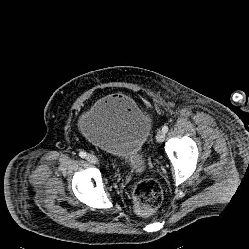Acute pancreatic necrosis (Radiopaedia 13560-18501 Axial C+ portal venous phase 134).jpg