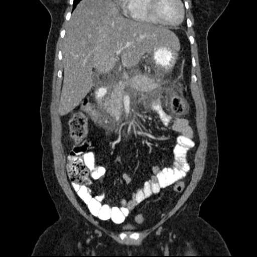 File:Acute pancreatitis (Radiopaedia 20829-20744 Coronal C+ portal venous phase 21).jpg