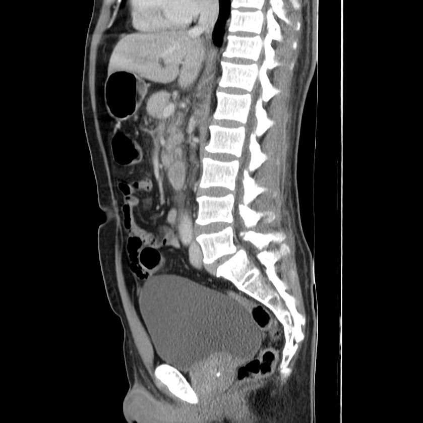 Acute pancreatitis (Radiopaedia 22572-22596 Sagittal C+ portal venous phase 27).jpg