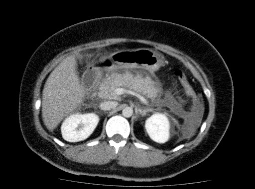 File:Acute pancreatitis (Radiopaedia 69236-79012 Axial C+ portal venous phase 33).jpg