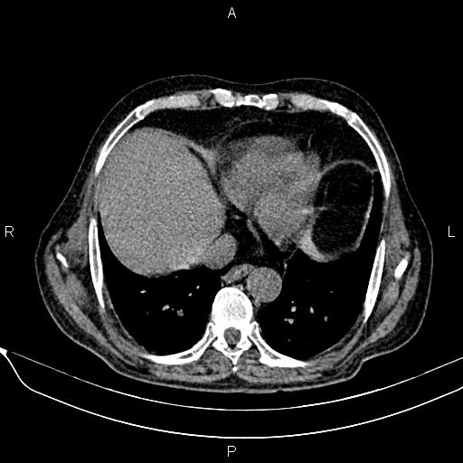 File:Acute pancreatitis (Radiopaedia 85146-100701 Axial non-contrast 17).jpg