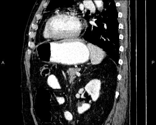 File:Acute pancreatitis (Radiopaedia 85146-100701 Sagittal C+ portal venous phase 64).jpg