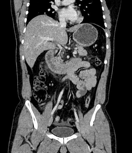 Acute pancreatitis (Radiopaedia 87428-103757 Coronal C+ portal venous phase 45).jpg