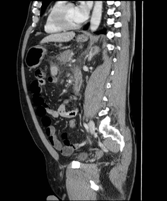 Acute pancreatitis - Balthazar E (Radiopaedia 23080-23110 Sagittal C+ portal venous phase 59).jpg