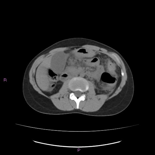 Acute pancreatitis secondary to stone at minor papilla and pancreatic divisum (Radiopaedia 76570-88333 Axial non-contrast 34).jpg