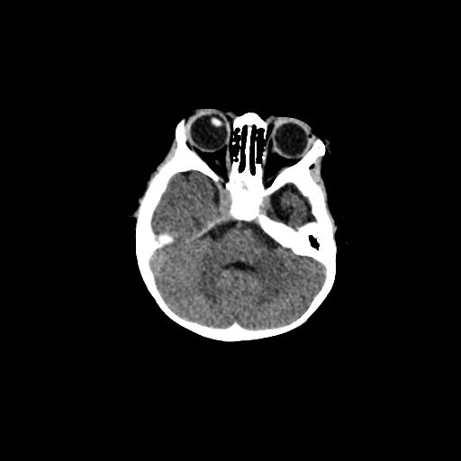 Acute phase of hemiconvulsion-hemiplegia epilepsy syndrome (Radiopaedia 29309-29744 Axial non-contrast 40).jpg