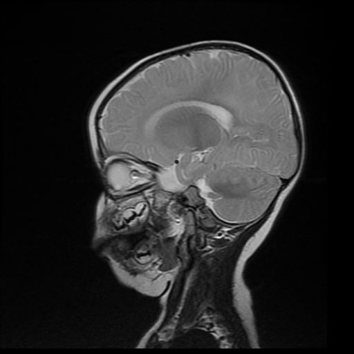 File:Acute phase of hemiconvulsion-hemiplegia epilepsy syndrome (Radiopaedia 29309-29745 Sagittal T2 14).jpg