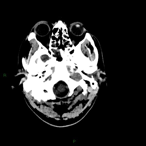 Acute posterior cerebral artery territory infarct (Radiopaedia 79329-92393 Axial non-contrast 13).jpg