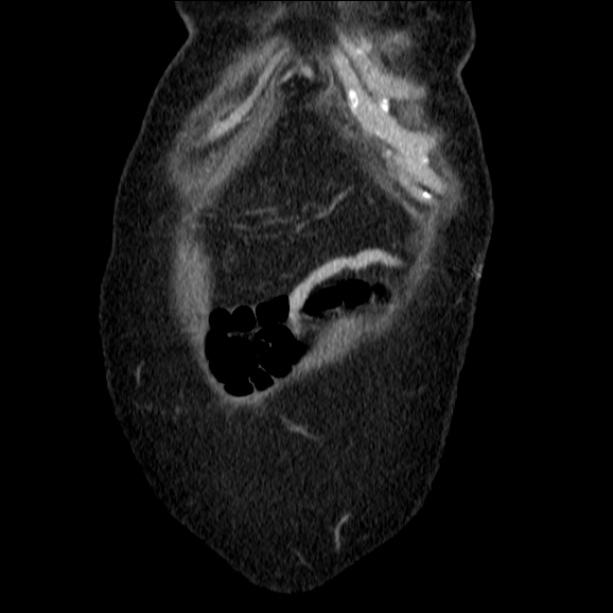 Acute pyelonephritis (Radiopaedia 26584-26729 C+ portal venous phase 10).jpg