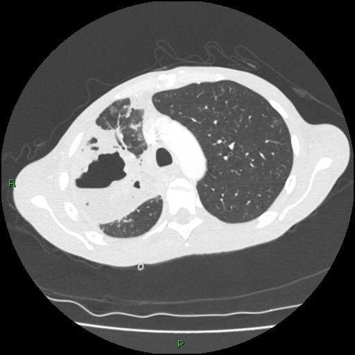 File:Acute right lung abscess (Radiopaedia 34806-36258 Axial lung window 56).jpg