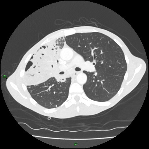 File:Acute right lung abscess (Radiopaedia 34806-36258 Axial lung window 79).jpg
