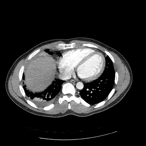 File:Acute segmental pulmonary emboli and pulmonary infarction (Radiopaedia 62264-70444 Axial C+ CTPA 81).jpg