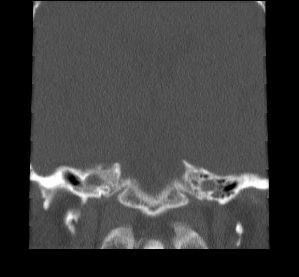 Acute sinusitis (Radiopaedia 23161-23215 Coronal bone window 61).jpg