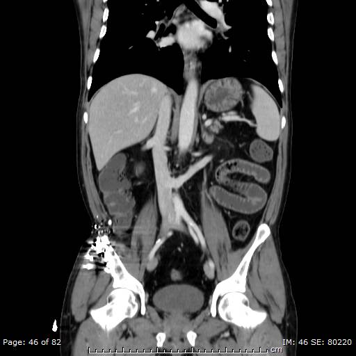 Acute superior mesenteric artery occlusion (Radiopaedia 43636-47060 Coronal C+ portal venous phase 31).jpg
