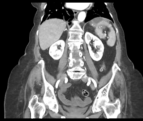 Acute superior mesenteric artery occlusion (Radiopaedia 43926-47418 Coronal C+ portal venous phase 31).png