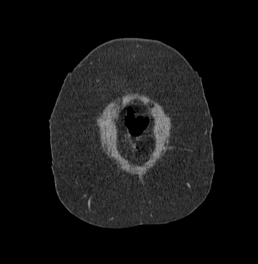 Acute superior mesenteric artery occlusion (Radiopaedia 51288-56960 Coronal C+ portal venous phase 2).jpg