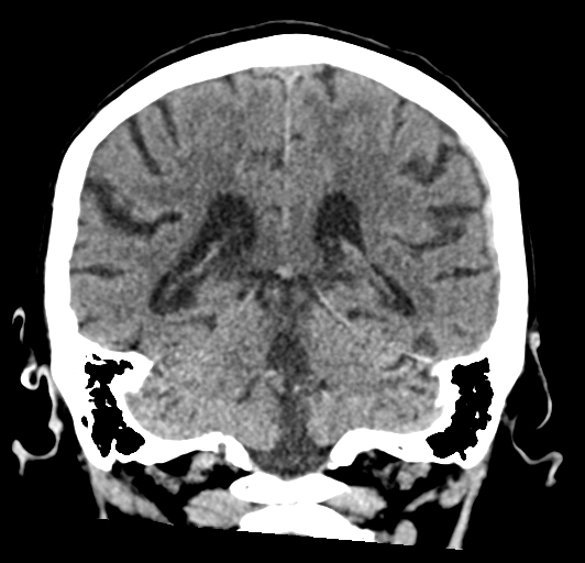 File:Acute traumatic subdural hematoma (Radiopaedia 82921-97257 Coronal non-contrast 57).jpg