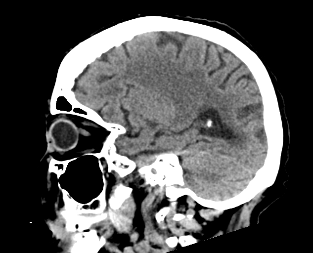 Acute traumatic subdural hematoma (Radiopaedia 82921-97257 Sagittal non-contrast 27).jpg