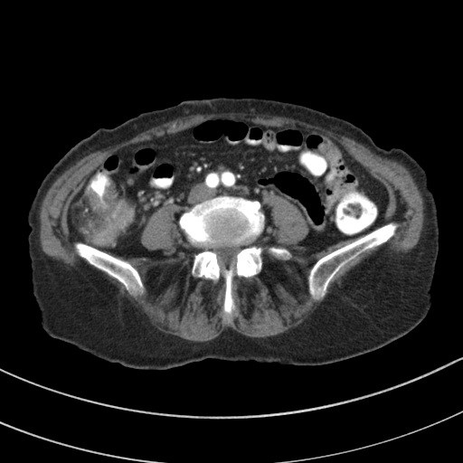 Adenocarcinoma of cecum (Radiopaedia 59222-66549 Axial C+ arterial phase 94).jpg