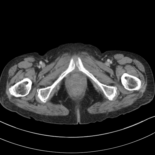 Adenocarcinoma of cecum (Radiopaedia 59222-66549 Axial C+ portal venous phase 166).jpg