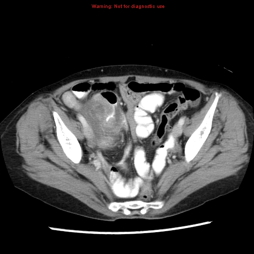 Adenocarcinoma of the colon (Radiopaedia 8191-9039 Axial liver window 63).jpg