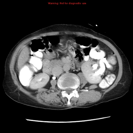 Adenocarcinoma of the colon (Radiopaedia 8191-9039 Axial renal excretory phase 21).jpg