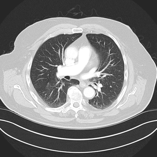 Adenocarcioma of rectum- T1 lesion (Radiopaedia 36921-38547 Axial lung window 28).png