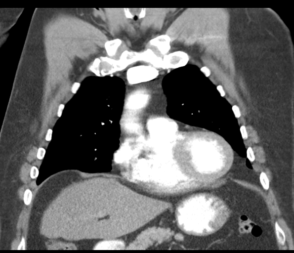 Adenocarcioma of rectum- T1 lesion (Radiopaedia 36921-38547 Coronal C+ arterial phase 22).png